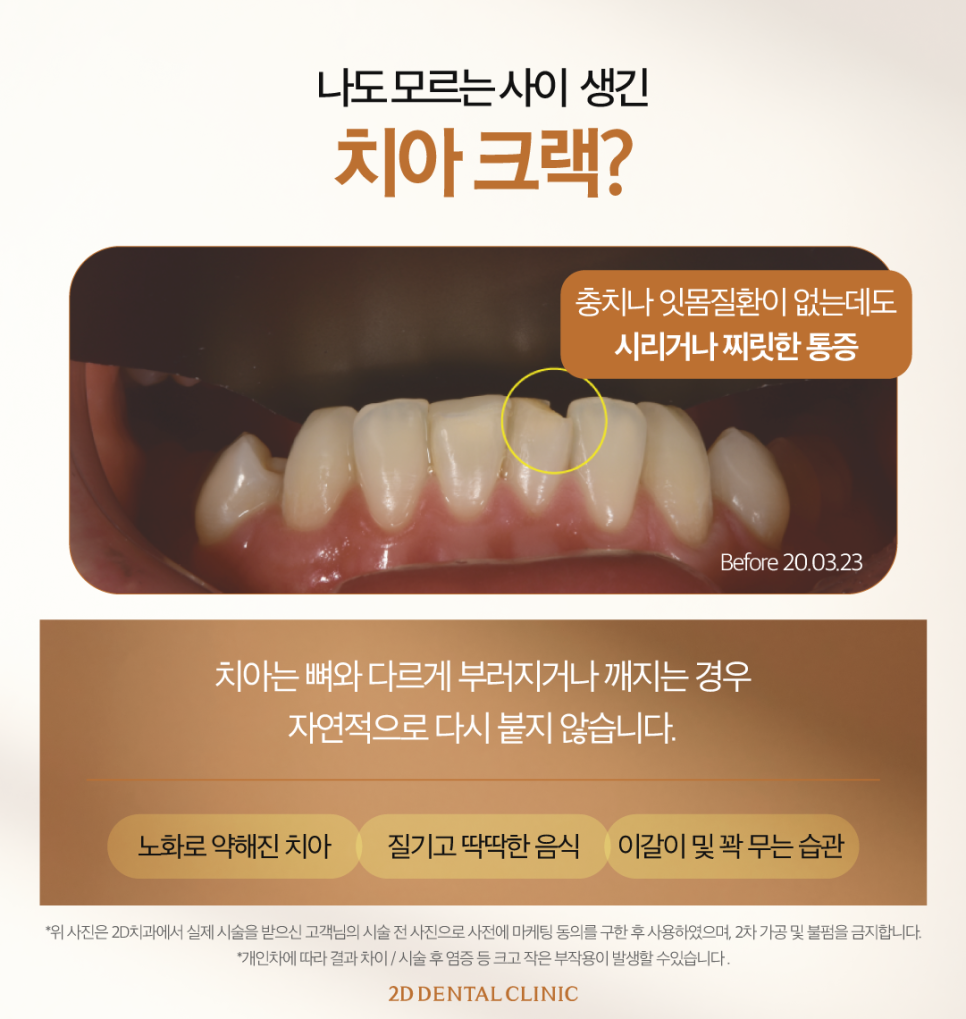 치아무삭제라미네이트 앞니크랙 이 손상 줄이면서 보완하기 관련 이미지 3
