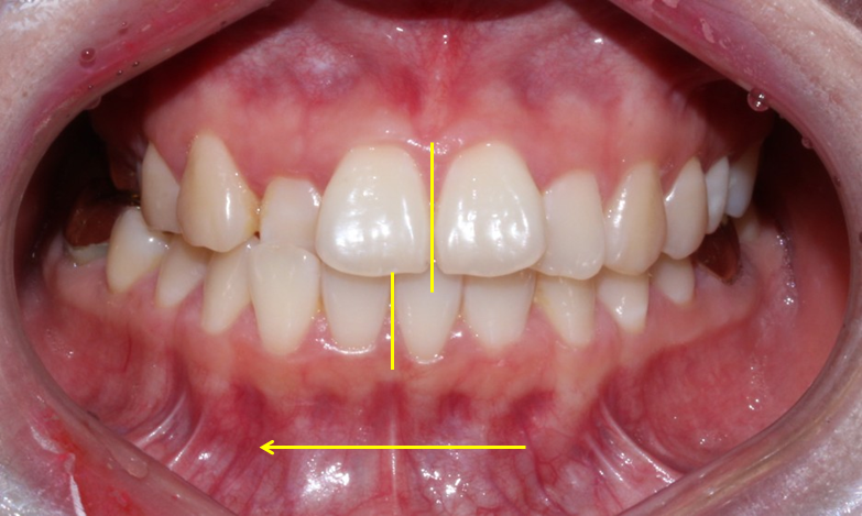 덧니 투명교정 8개월 치료 사례 관련 이미지 2
