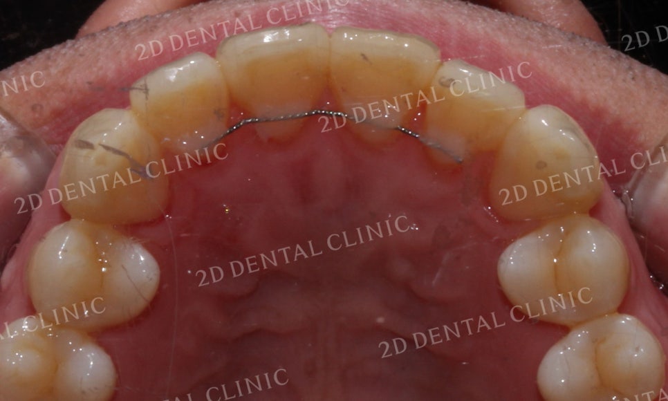 [투디교정] 부정교합 앞니교정을 투디교정으로 고르게! by.투디치과(2D치과) 관련 이미지 16