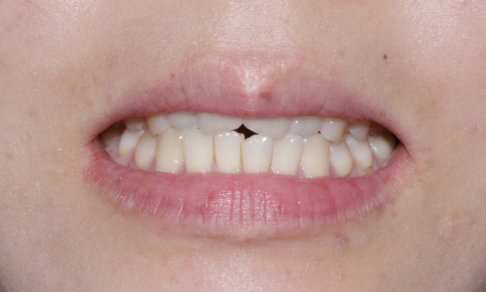 안 보이는 교정!2D교정 잘하는 강남 신논현 근처 2D치과! 관련 이미지 3