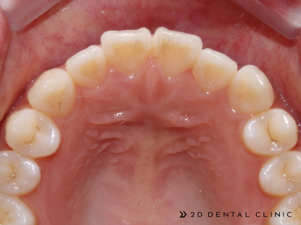 케이스로 확인하는 토끼이빨, 교정전문 2D치과 관련 이미지 9