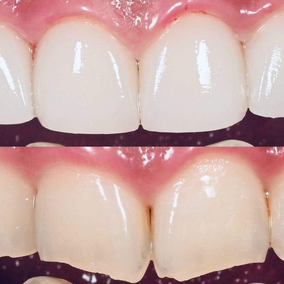 무삭제라미네이트후기 많은 고객님들의 찐후기가 많은 2D치과 관련 이미지 6