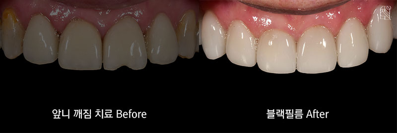 앞니가 깨졌을 때 치료방법은? 관련 이미지 9