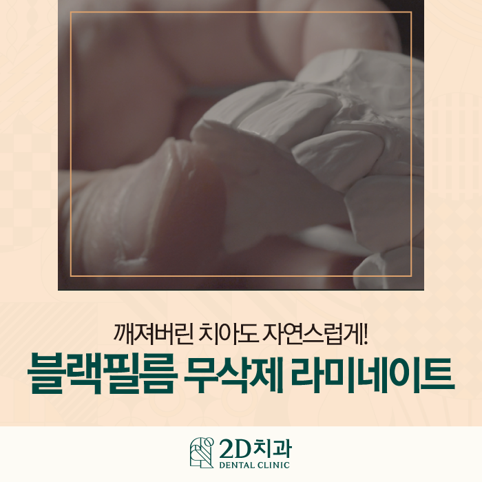 라미네이트무삭제 치아깨짐에도 자연스럽게 관련 이미지 1