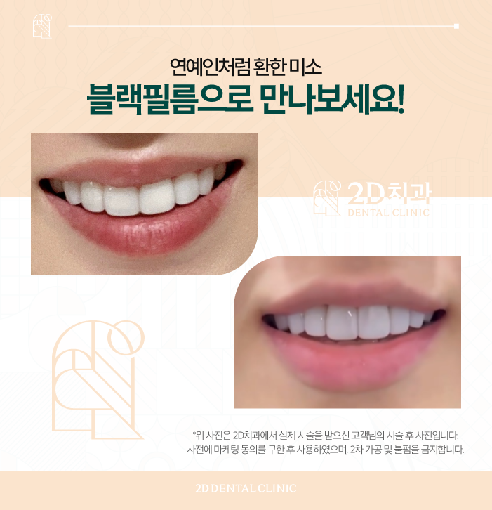 소중한 자연치 손상 없는 치아무삭제라미네이트 블랙필름 관련 이미지 6