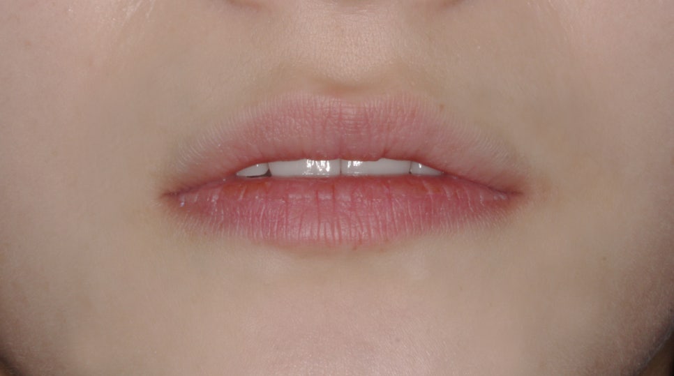 교정일기:앞니 부분 블링스(라미네이트) 심리보철 진료과정 후기 관련 이미지 6