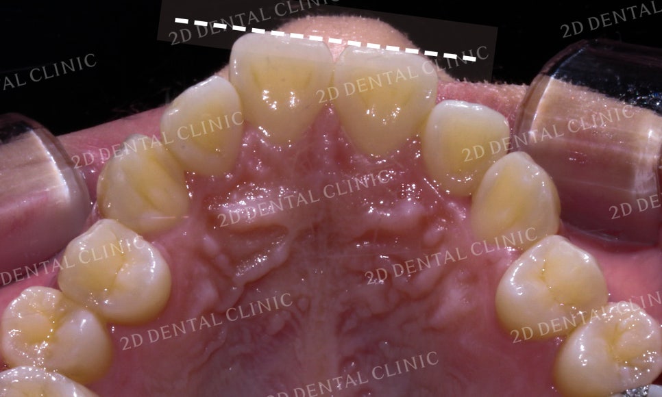 토끼앞니, 튀어나온 앞니 부분교정 후기! by.투디치과(2D치과) 관련 이미지 14