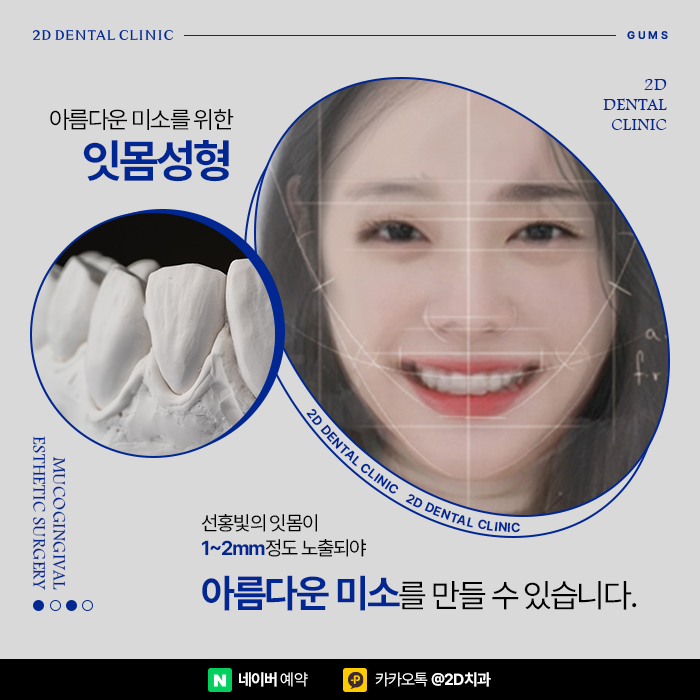 치아관리만큼 중요한 잇몸관리, 잇몸염증, 잇몸퇴축 예방하는 방법, 신논현 잇몸성형 관련 이미지 3