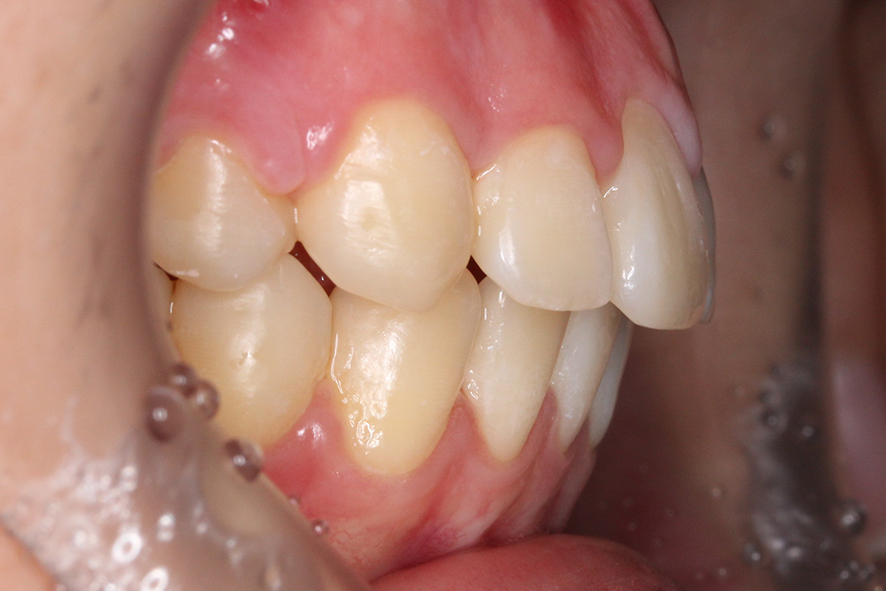 입돌출 데이몬교정 Case1 관련 이미지 11