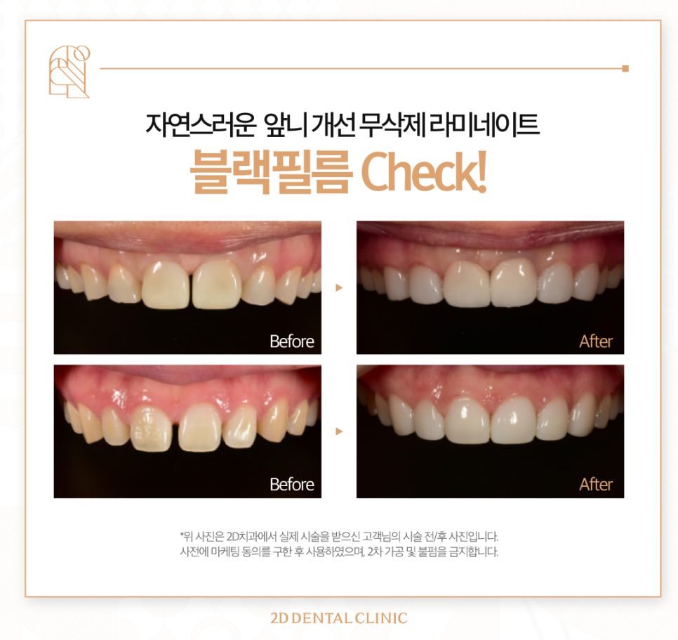 무삭제라미네이트가격 치아미백치과 앞니 고민 있다면 관련 이미지 7