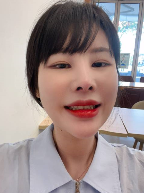 현직 2D 치과위생사가 시술한 무삭제 라미네이트 블랙필름 옥니개선 후기 관련 이미지 2