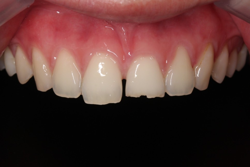 [투디치과] 블랙필름(비스포크) 치료의 다양한 사례 관련 이미지 31