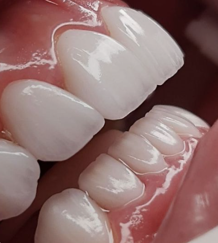 치아성형은 치아삭제 없는 무삭제 라미네이트 블랙필름 관련 이미지 3