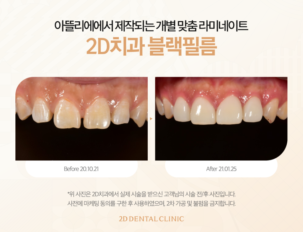 광주무삭제라미네이트 앞니성형 투디에서 디테일한 치아 개선을 관련 이미지 6