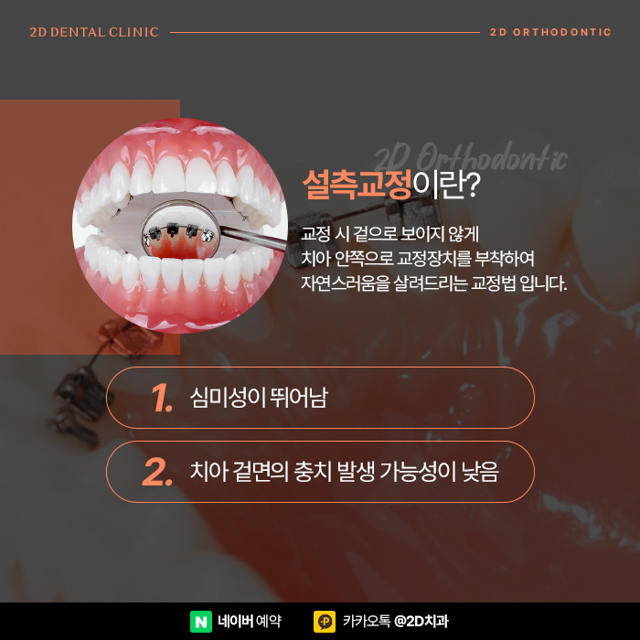 효과적인 설측교정을 위한 정보, 신논현 교정전문의치과 관련 이미지 2