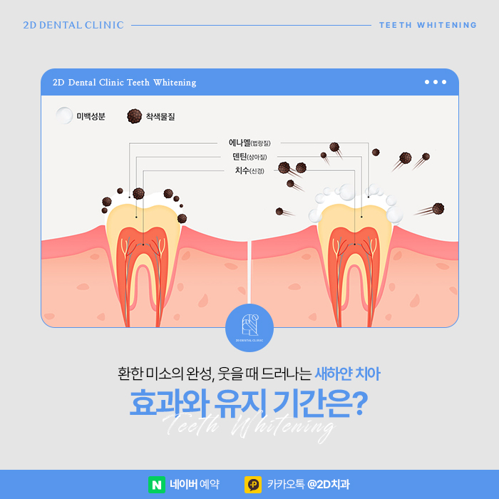 치과 치아미백치료 효과, 유지기간은? 강남 누런니 개선 관련 이미지 2