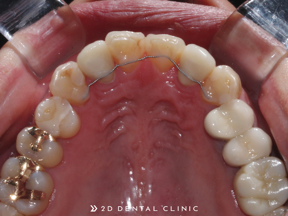나비치아, 앞니 부분 2D교정으로 교정 기간 단축! 관련 이미지 13