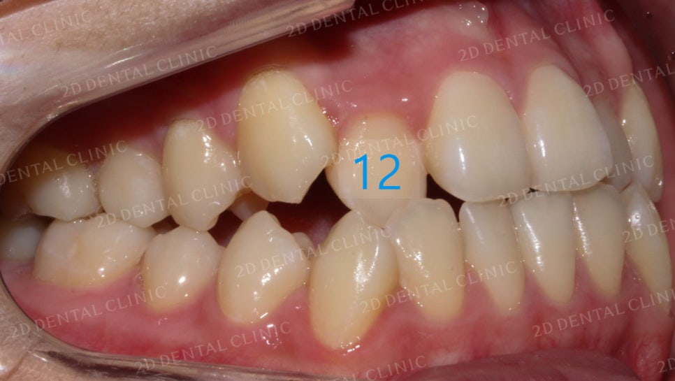 덧니치아교정, 클리피씨 전체교정으로 완벽하게! by.투디치과(2D치과) 관련 이미지 12
