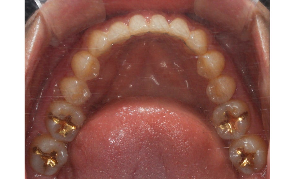 절단교합 클리피씨 교정 방법 관련 이미지 14