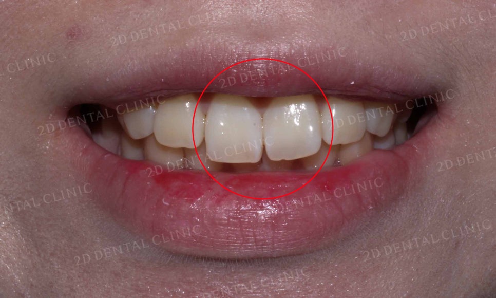 강남역 치과에서 앞니부분 설측 2D(투디)교정으로 토끼앞니 탈출한 후기 관련 이미지 3