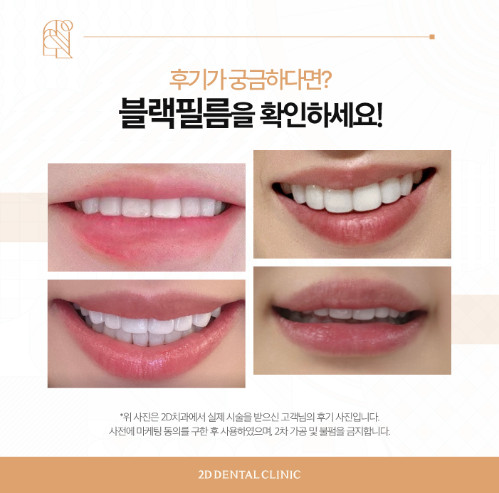 내 치아는 그대로! 인천무삭제라미네이트 관련 이미지 6