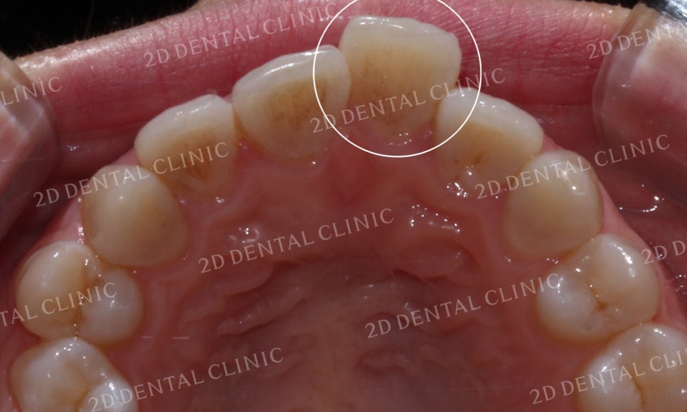 [투디교정] 덧니교정, 앞니교정으로 치열을 고르게! by.투디치과(2D치과) 관련 이미지 6