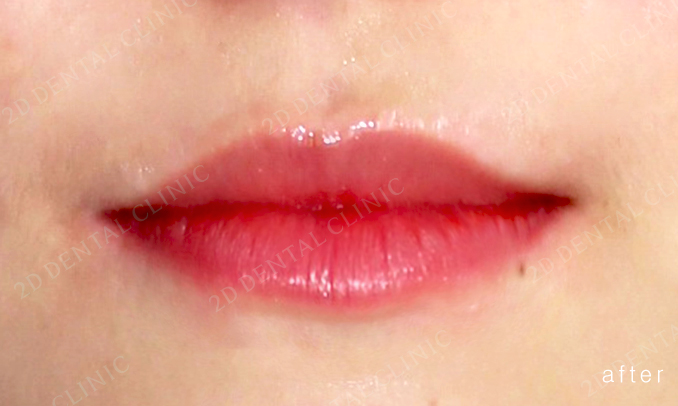 우디의 교정 일기ㅣ부정 교합 치아교정 후기 관련 이미지 11