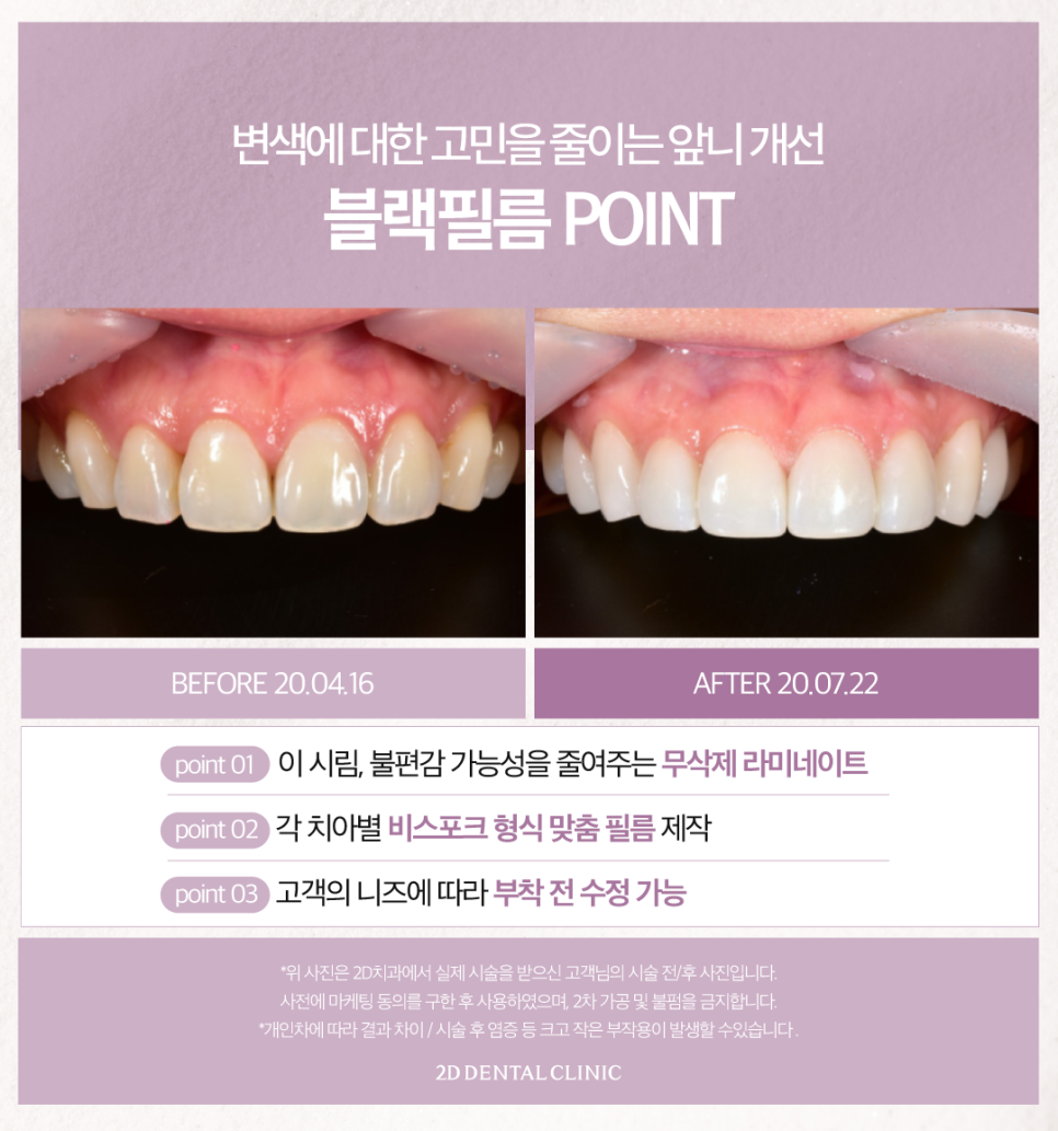 대구무삭제라미네이트 커피치아변색 누런 이 개선 가능할까요? 관련 이미지 6