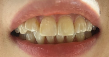 부분 라미네이트 치아 심미치료는 무삭제로 진행가능한 블랙필름 관련 이미지 4