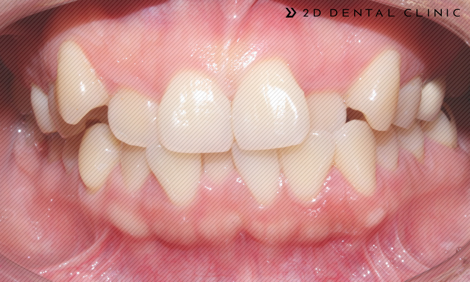 발치교정 돌출입 케이스, 교정전문 2D치과 관련 이미지 7