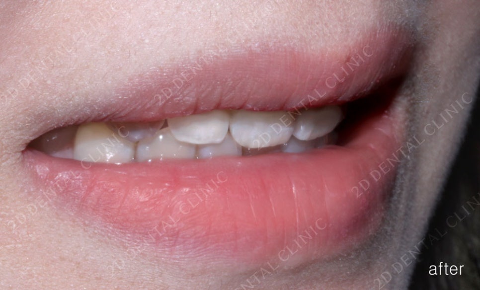 우디의 교정일기ㅣ토끼이빨 치아교정(ft.클리피씨 전체교정) 관련 이미지 13