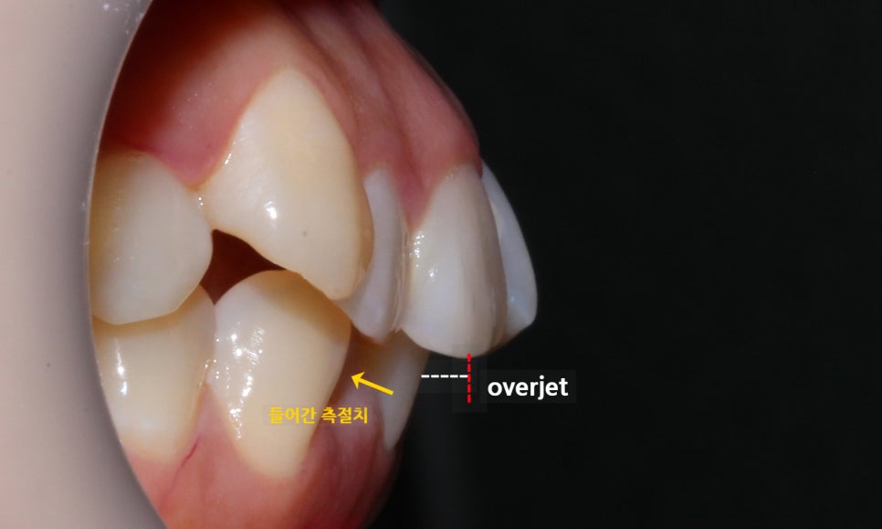 역삼역치과 송곳니덧니 crowding Case 관련 이미지 3