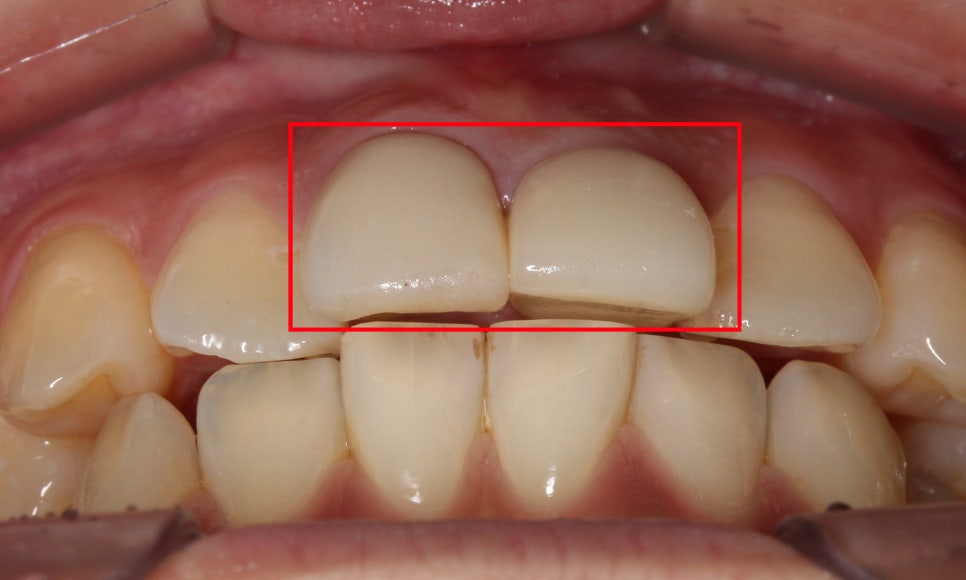 토끼앞니교정, PFM크라운 재보철을 동시에 치료하는 방법? 관련 이미지 2