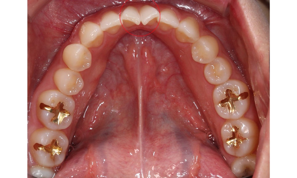 절단교합 클리피씨 교정 방법 관련 이미지 7