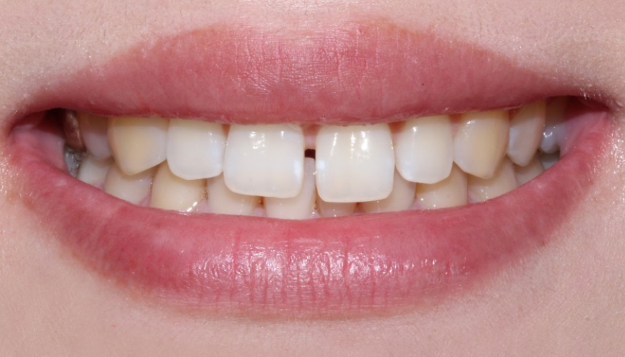 치료목적으로 진행되는 치아교정과 무삭제라미네이트 관련 이미지 4