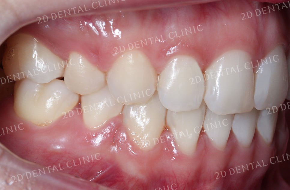 비대칭 앞니, 돌출앞니를 전체 교정으로 교정하고 싶다면!? by.투디치과(2D치과) 관련 이미지 20