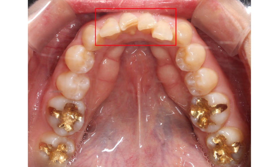 양악교정 송곳니교정 중심으로 관련 이미지 7