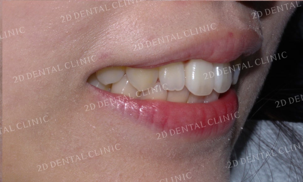 [앞니교정]토끼앞니교정, 부분교정으로 토끼이빨 탈출하기! by.투디치과(2D치과) 관련 이미지 3