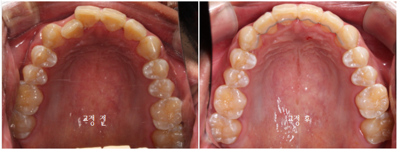 앞니 덧니 고민, 부분 설측 교정으로 해결한 사례 관련 이미지 20