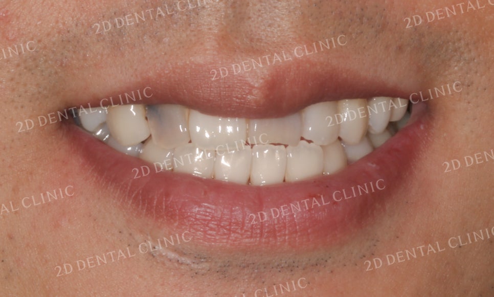 치아변색, 까맣게 변한 변색치를 블링스(Blinx)로 수복하기! by. 투디치과(2D치과) 관련 이미지 2