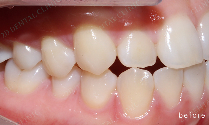 우디의 교정 일기ㅣ부정 교합 치아교정 후기 관련 이미지 6