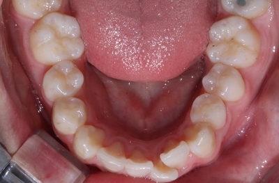 투명교정. 그것이 알고싶다! 관련 이미지 2