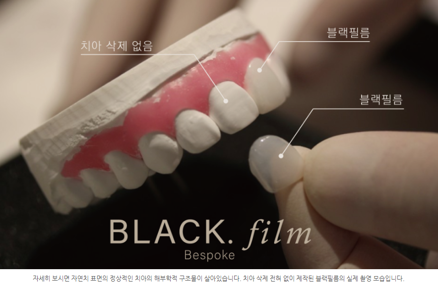 연예인라미네이트 어디가 잘할까? 관련 이미지 12