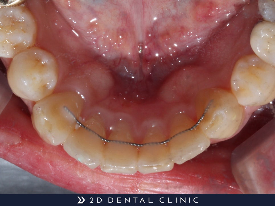 아랫니 부분교정, 2D치과에서 2D교정! 관련 이미지 4