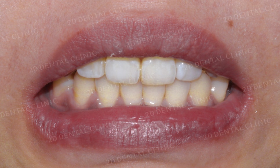 [2D교정] 나비치아, 앞니교정 설측교정으로 빠르게 하는 방법! by.2D치과(투디치과) 관련 이미지 10