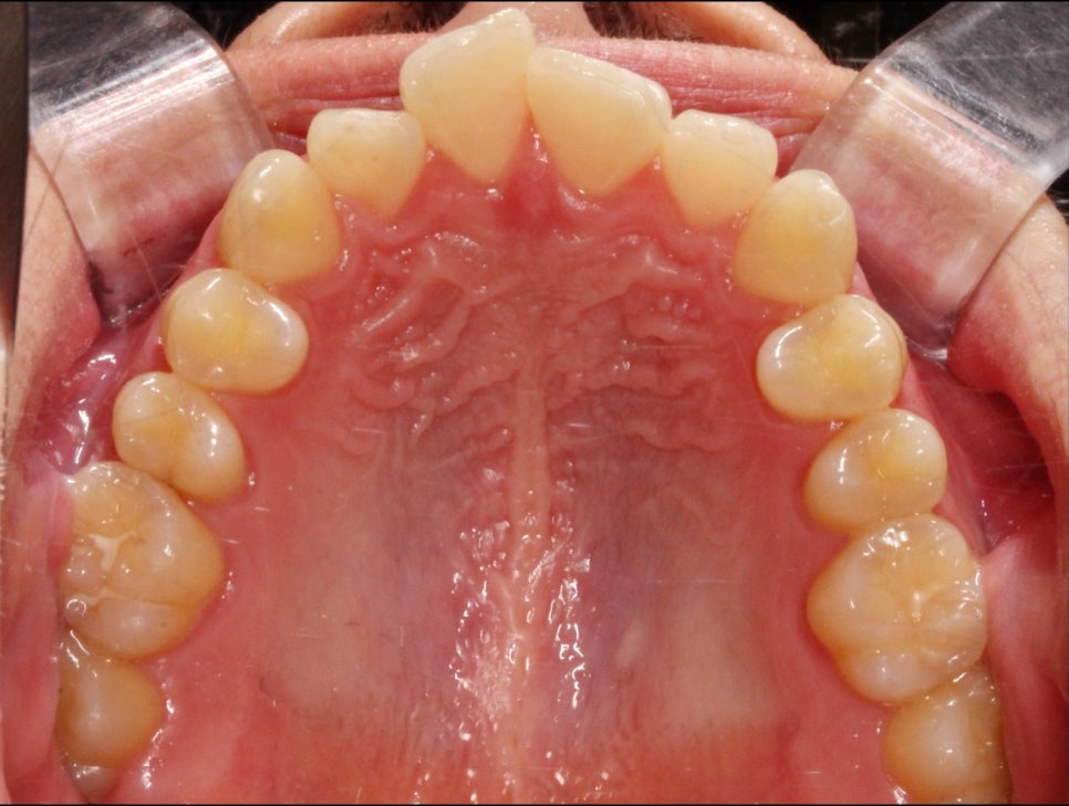 부분교정으로 삐뚤어진 앞니 예뻐지는 방법 관련 이미지 7