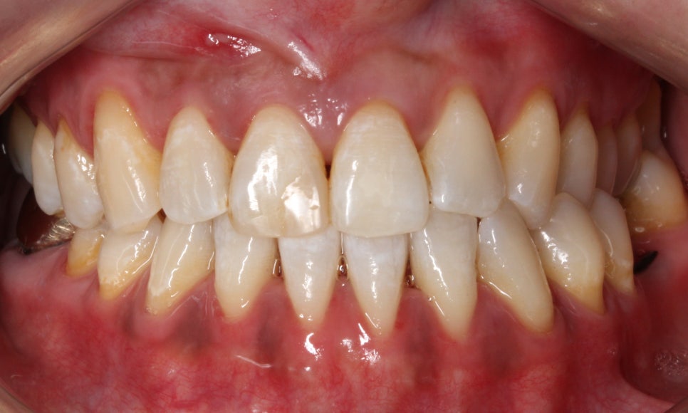 2D(투디)치과 블링스, 추천합니다!(깨진 앞니, 돌출앞니, 벌어진 앞니, 치아 노후, 치아 변색) 관련 이미지 2