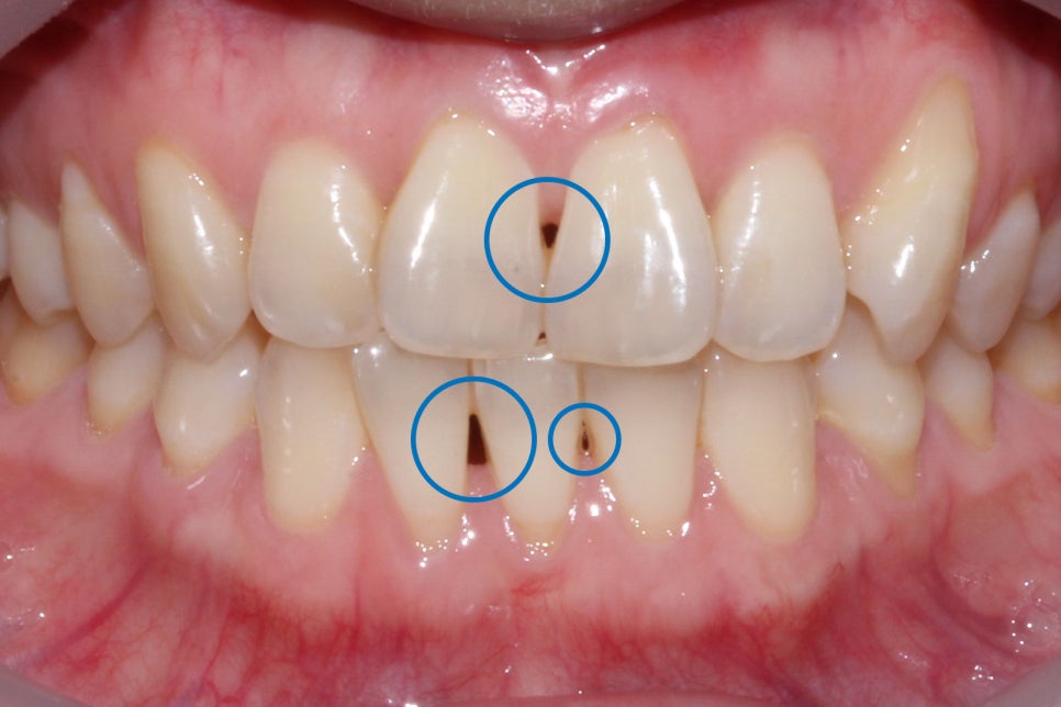 나비치아 교정 케이스 전후비교, 교정전문 2D치과 관련 이미지 4