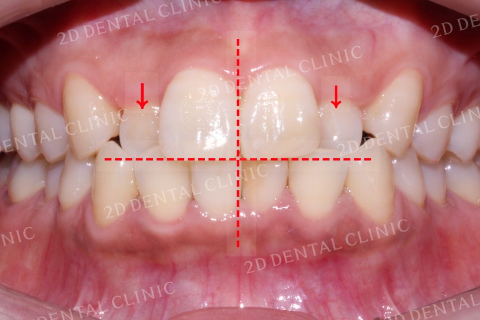 반대교합으로 물리는 치아를 바른 교합으로 교정하기! by.투디치과(2D치과) 관련 이미지 4