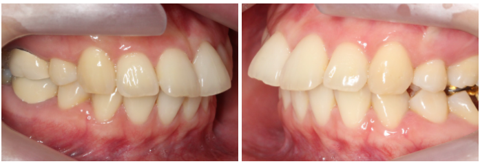 토끼앞니교정 부분교정으로 단기완성 관련 이미지 5